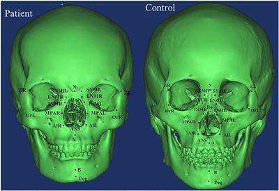 Craniofacial development in patients of Tessier No.0 cleft with a bifid nose using 3D computed tomography